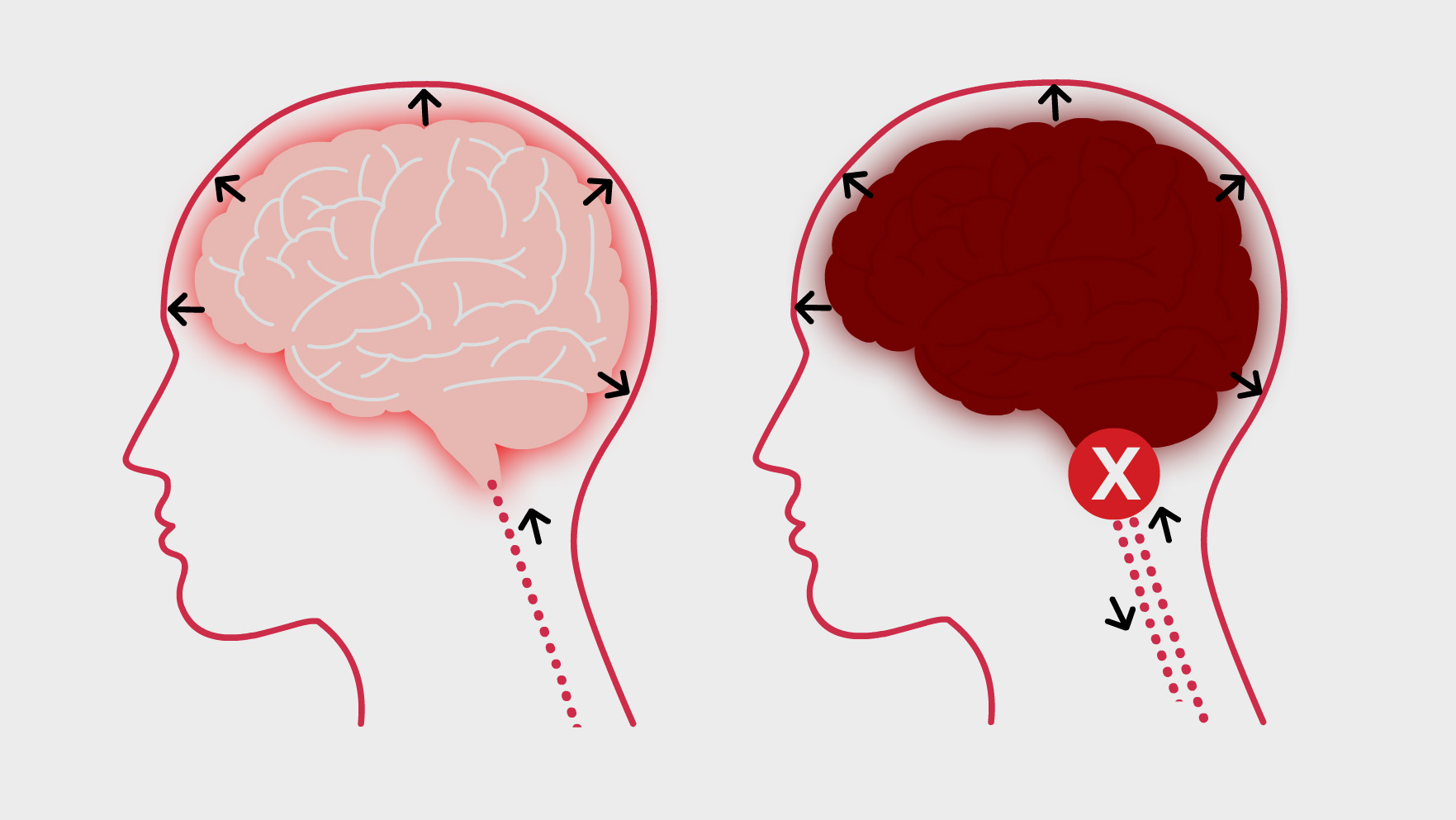 Understanding Brain Death | Chain of Life