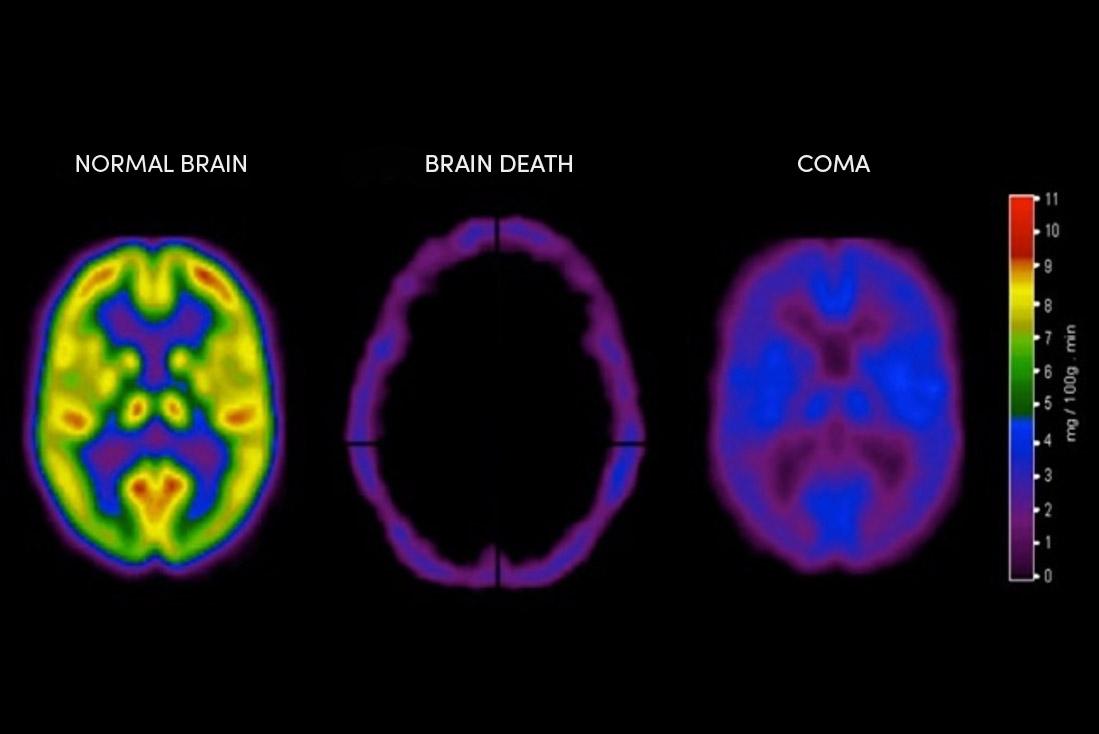 Understanding Brain Death | Chain Of Life